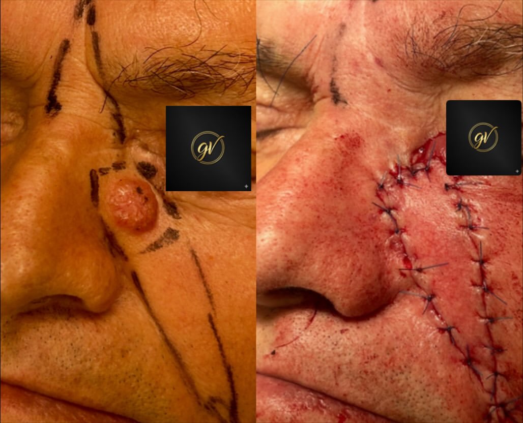 Prima e Dopo – Lembo di Avanzamento per Carcinoma Cutaneo