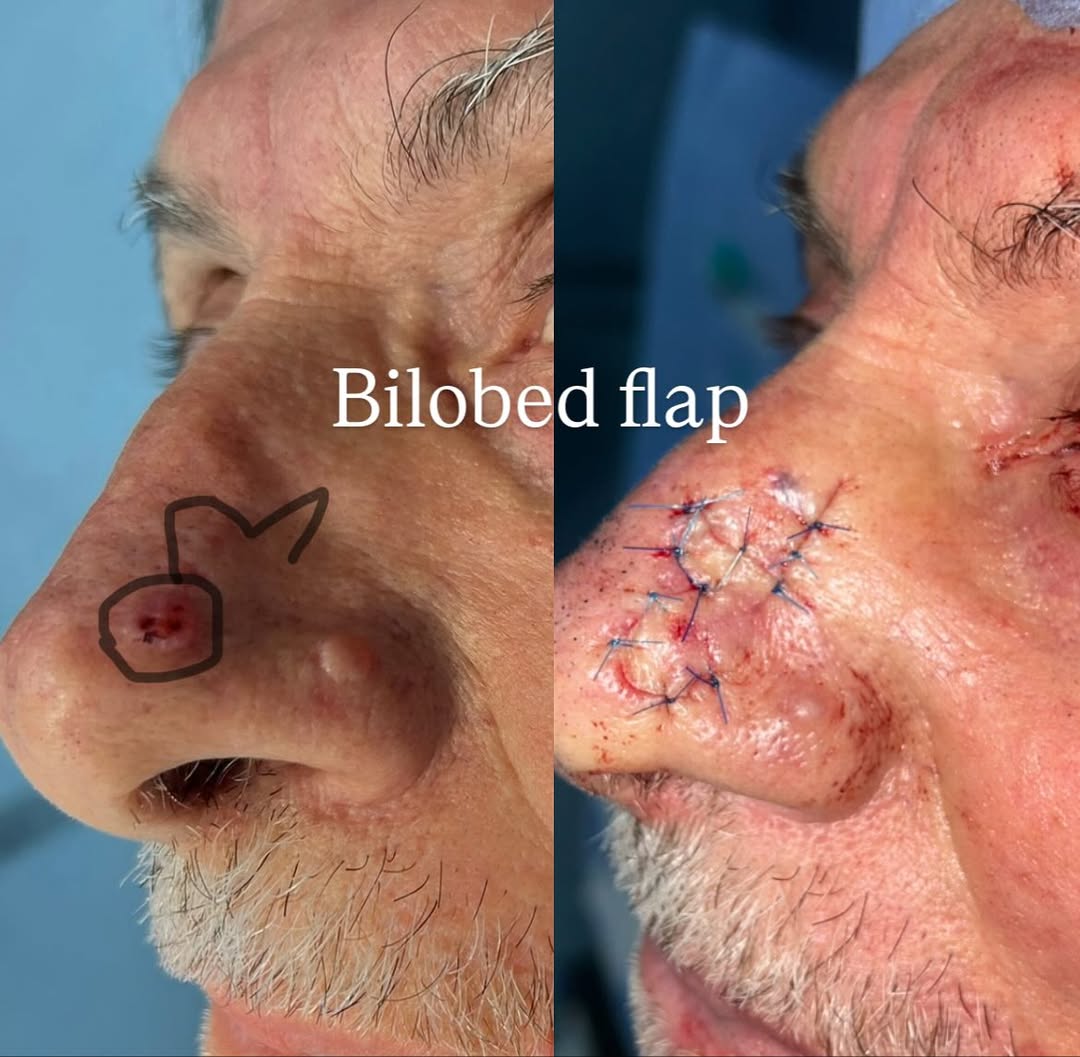 Prima e Dopo – Lembo Bilobato per Carcinoma Basocellulare