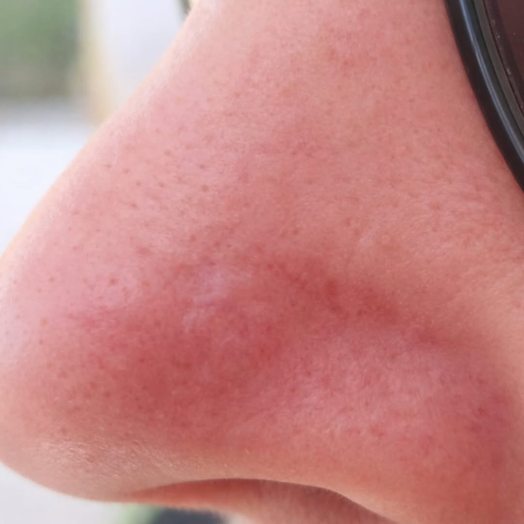 Dopo – Lembo Bilobato