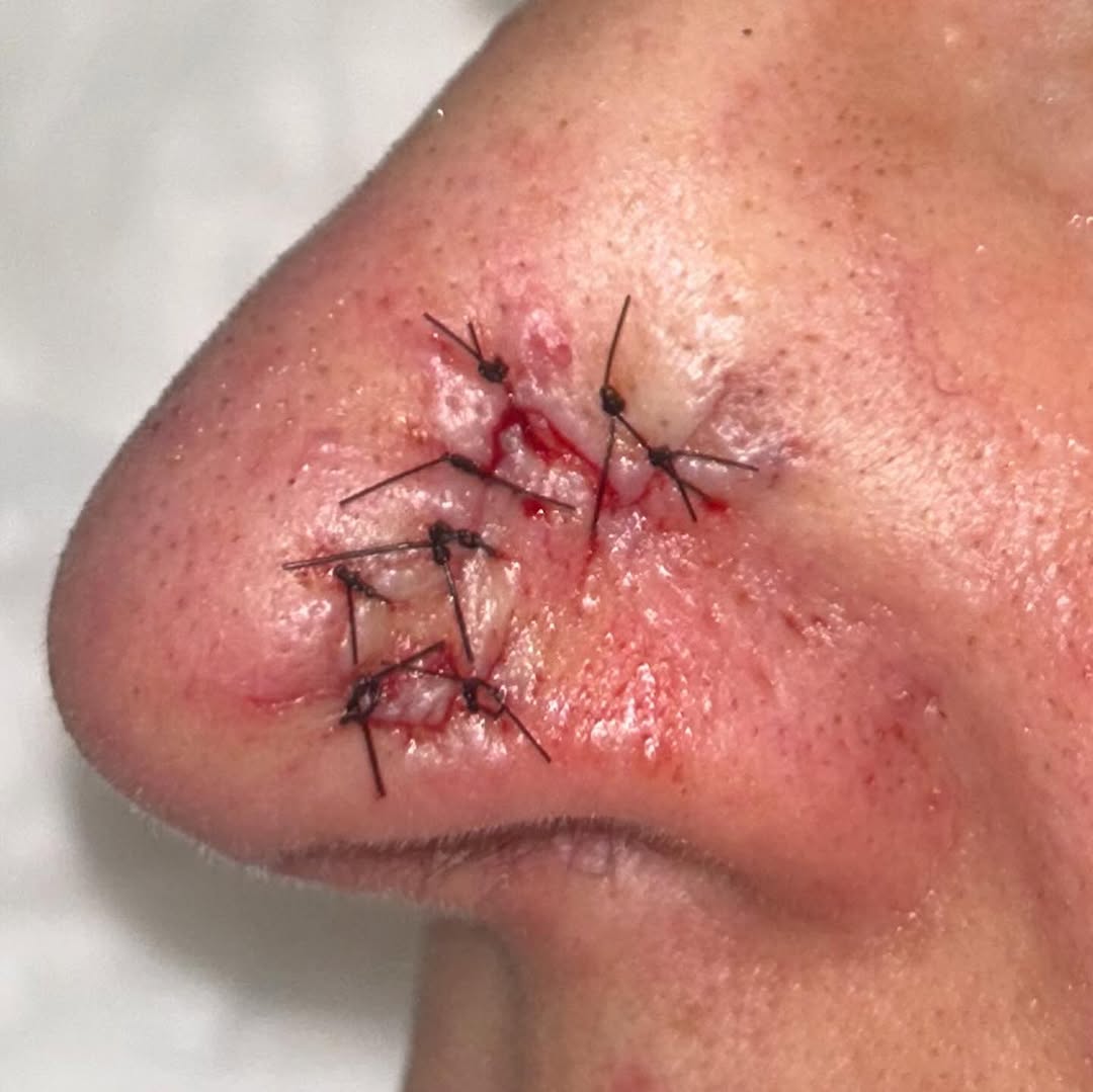 Prima – Lembo Bilobato