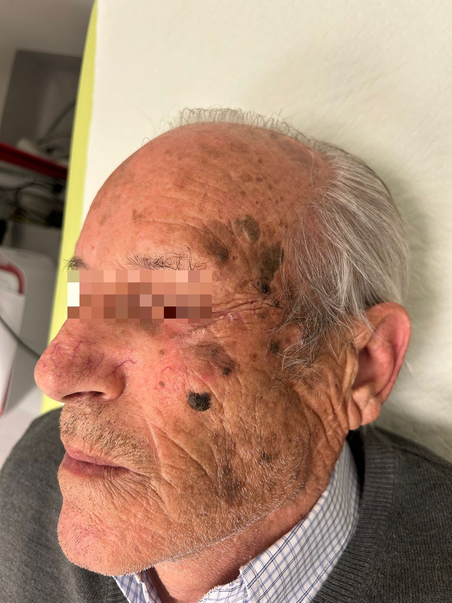 Dopo – Lembo di Mustardè per Carcinoma Squamocellulare