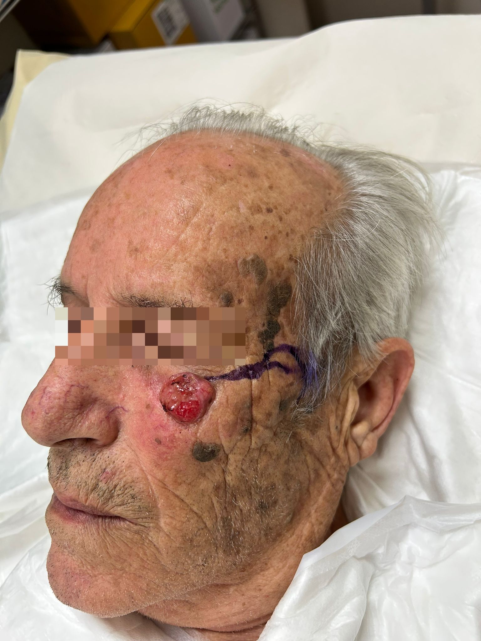 Prima – Lembo di Mustardè per Carcinoma Squamocellulare